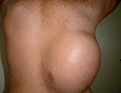 Chest Wall Tumours