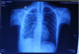 Post operative X-Ray after VATS decortication