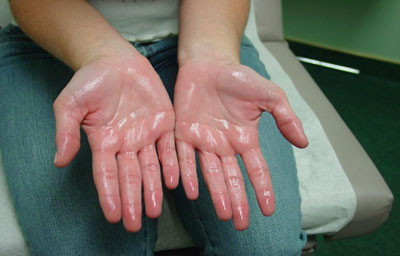 Hyperhidrosis Hyperhidrosis