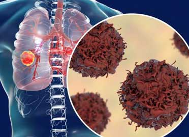 Lung cancer treatment in Gurgaon