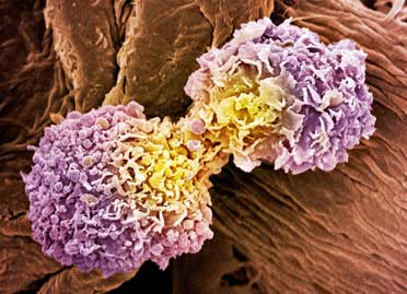 Chest Wall Tumours Treatment In Delhi and Gurgaon Chest Wall Tumours Treatment In Delhi and Gurgaon