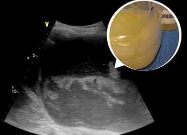 Empyema Treatment in Delhi and Gurgaon Empyema Treatment in Delhi and Gurgaon