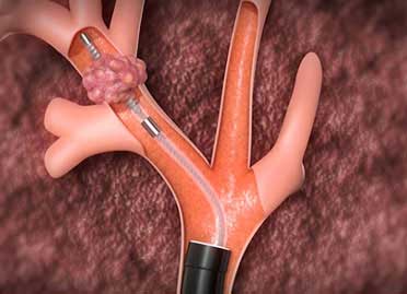 Tracheal stenosis treatment in Gurgaon and Delhi Tracheal stenosis treatment in Gurgaon and Delhi