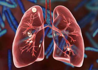 Post Tubercular Sequale Post Tubercular Sequale