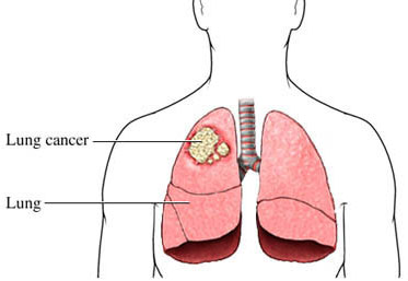 Lung cancer treatment in Delhi and Gurgaon