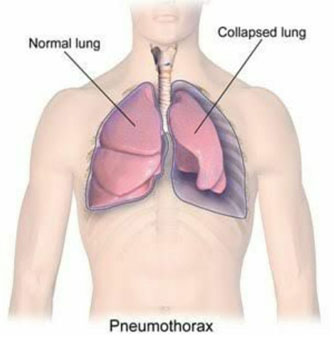 Pneumothorax