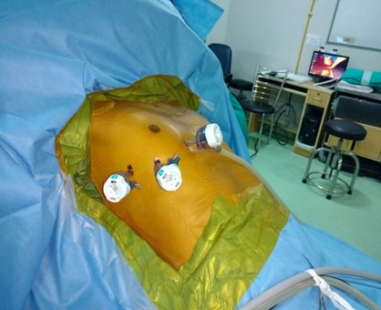 Ports for VATS Thymectomy