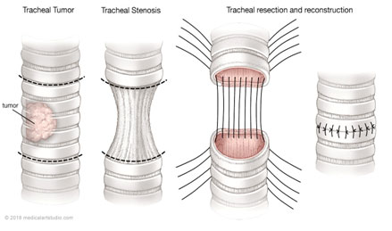 Tracheal stenosis treatment