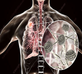 Post Tubercular Sequelae such as Bronchiectasis, Aspergilloma, Bronchial stenosis Post Tubercular Sequelae such as Bronchiectasis, Aspergilloma, Bronchial stenosis