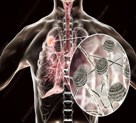 Post Tubercular Sequelae such as Bronchiectasis, Aspergilloma, Bronchial stenosis